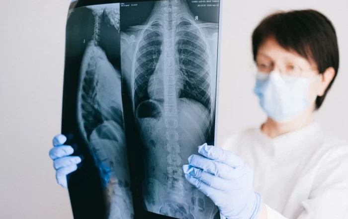 A doctor examining a chest X-ray showing the rib cage