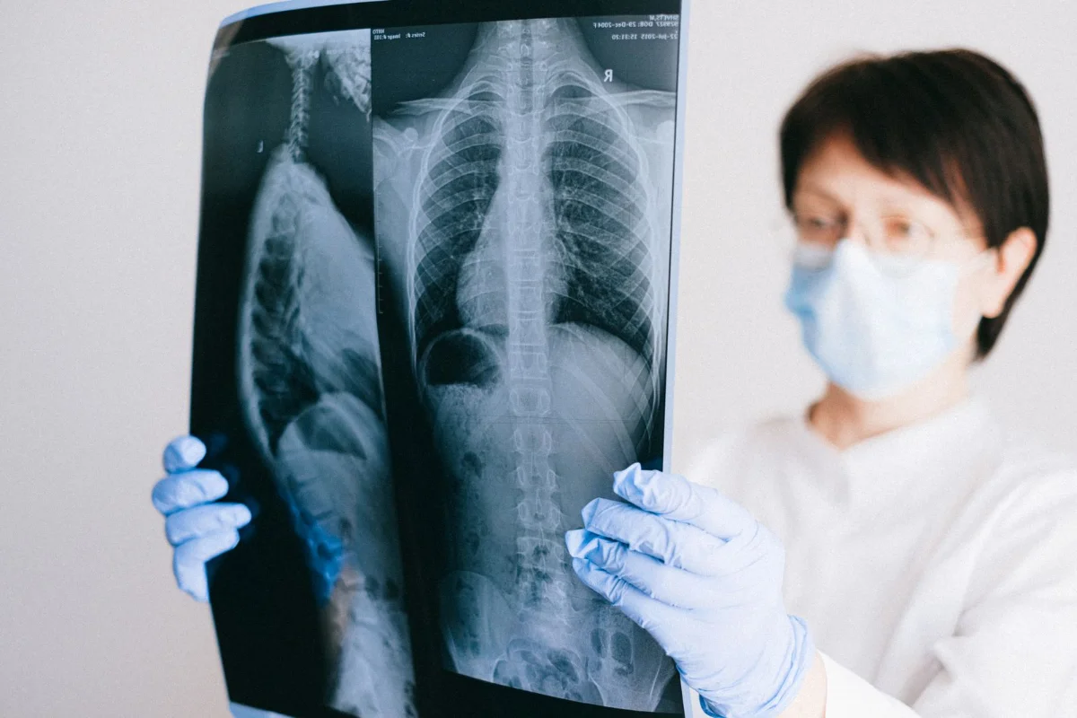 A doctor examining a chest X-ray showing the rib cage